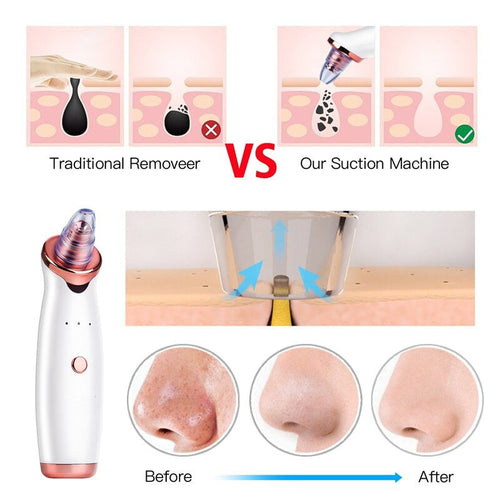 Vacuum Blackhead Remover Tool